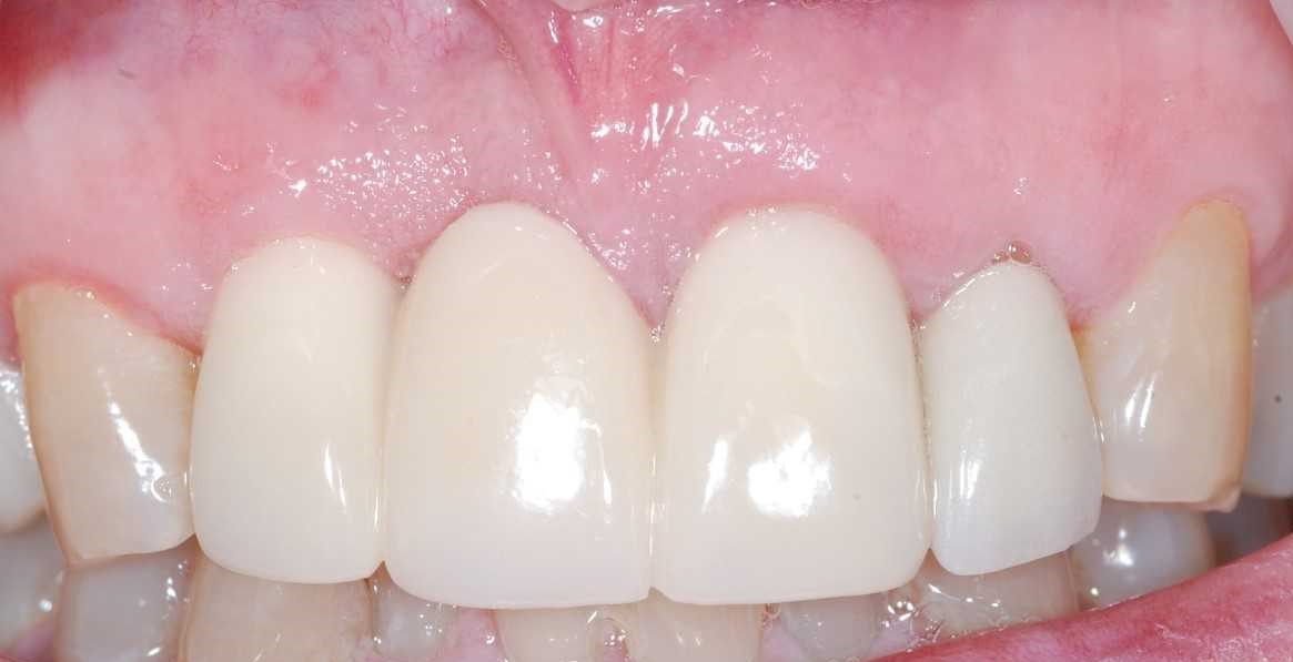 Dental Implants Quad Cities Periodontics